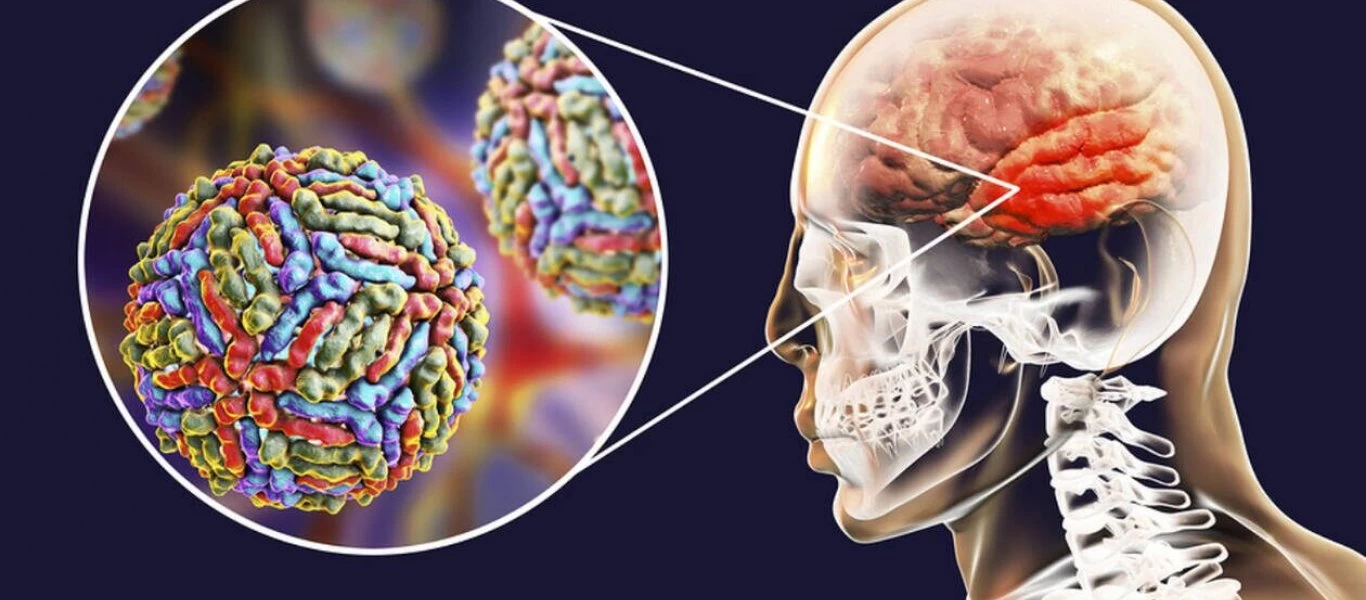 Εγκεφαλίτιδα: Αίτια, συμπτώματα και πως να αντιμετωπίσετε την επικίνδυνη νόσο